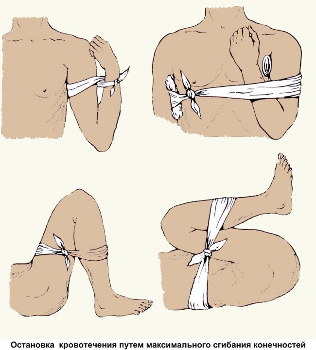 В случаях артериального кровотечения необходимо