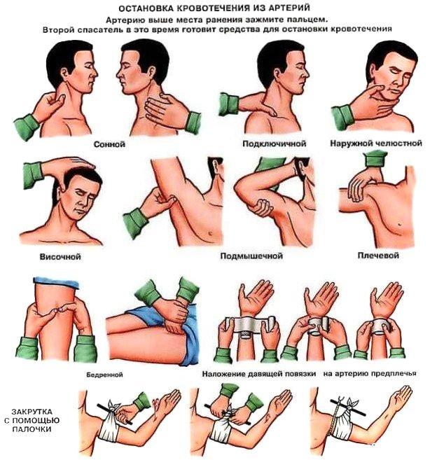В случаях артериального кровотечения необходимо