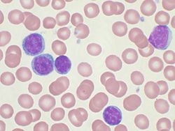 Chronic lymphocytic leukemia.jpg