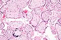 CMV placentitis1.jpg