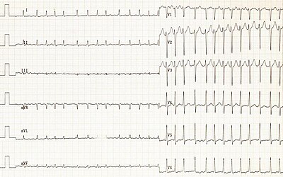 Heart conduct atrialfib.gif