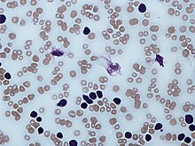 Chronic lymphocytic leukemia.jpg