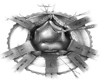 keyhole