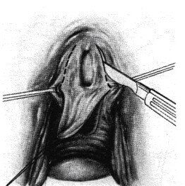 keyhole