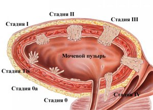 Что такое  переходно-клеточный рак, и как он проявляется в мочевом пузыре