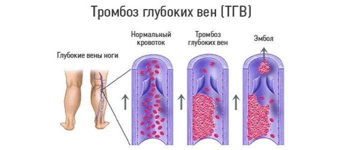 Болезни сосудов нижних конечностей