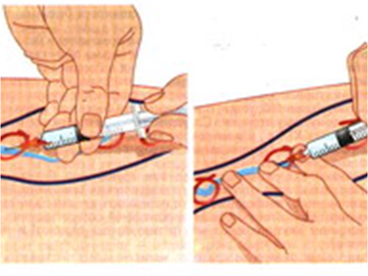 Как ставить укол в вену. Внутривенная инъекция в стопы.