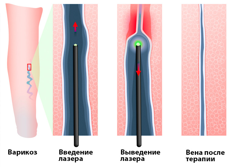 Лазерная терапия вен