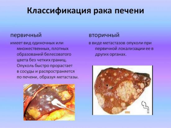 Классификация рака печени