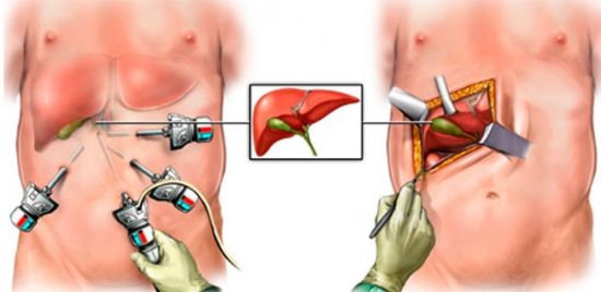 Лапароскопия желчного пузыря