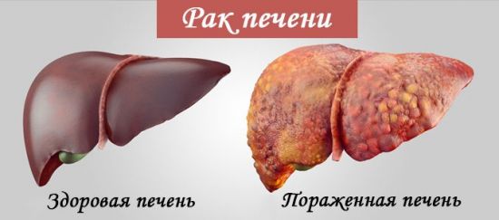 Рак печени