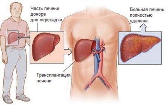 Трансплантация печени