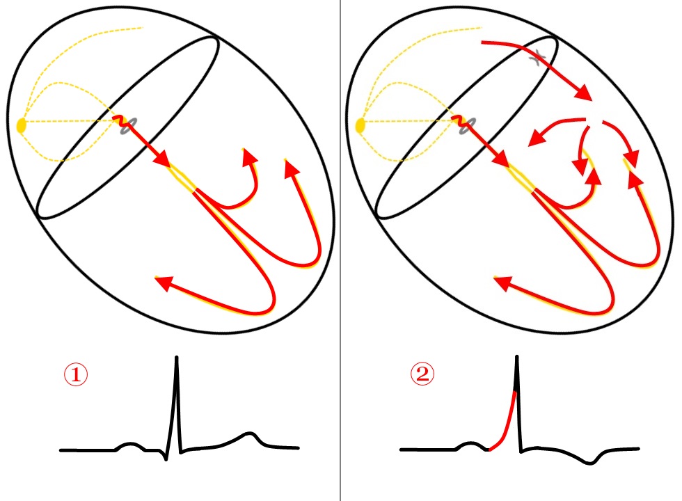 Figure 1. Normal conduction (Example 1) and conduction with an accessory pathway (Example 2)