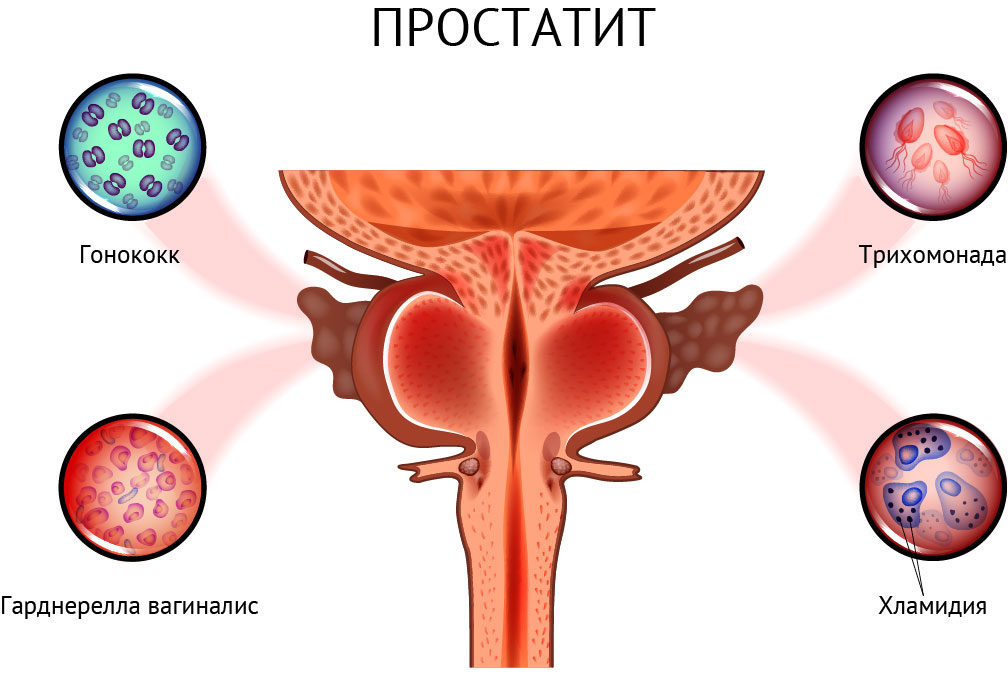 Простатит.jpg