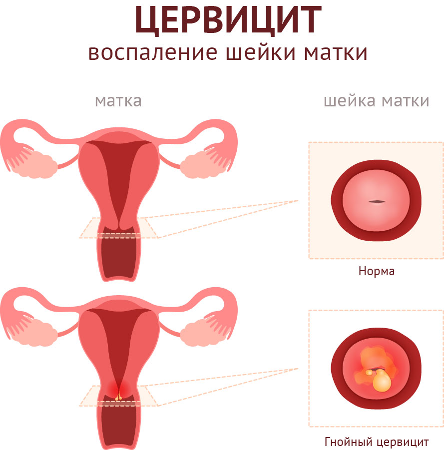 Цервицит. Воспаление шейки матки.jpg