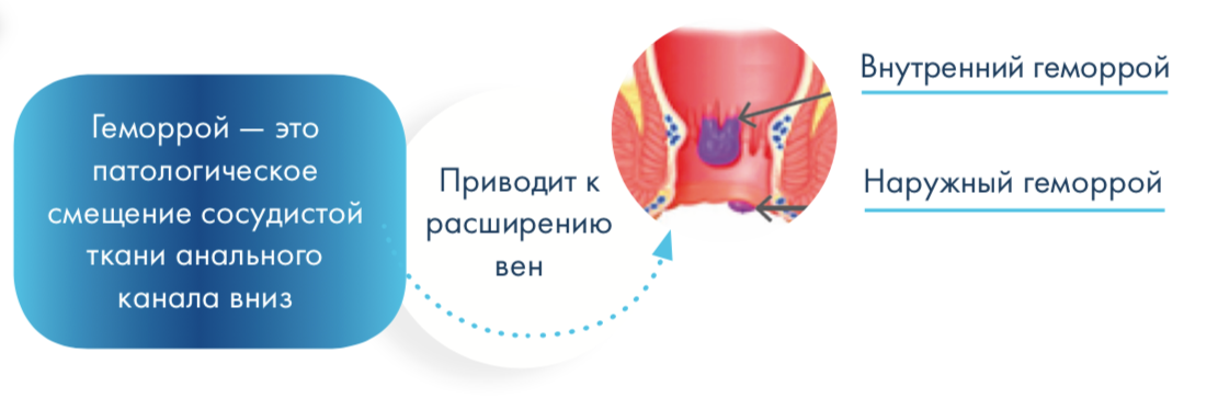 Геморрой влияет на потенцию. Наружный геморроидальный узел. Хронический внутренний геморрой. Геморрой внутренние узлы.