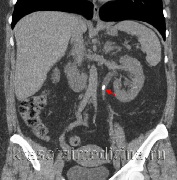КТ органов брюшной полости и забрюшинного пространства. Плотный конкремент в верхней трети левого мочеточника
