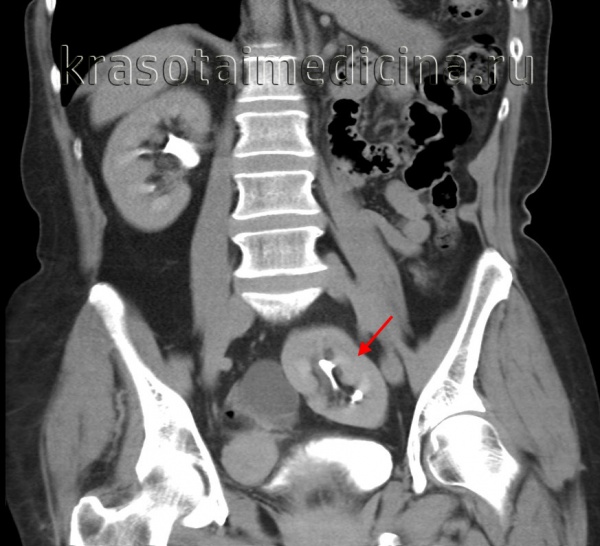 КТ-урография. Тазовая дистопия левой почки (другой пациент).