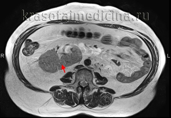 МРТ ОБП и забрюшинного пространства. Тазовая перекрестная дистопия левой почки