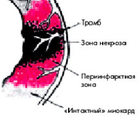 Трансмуральный инфаркт миокарда