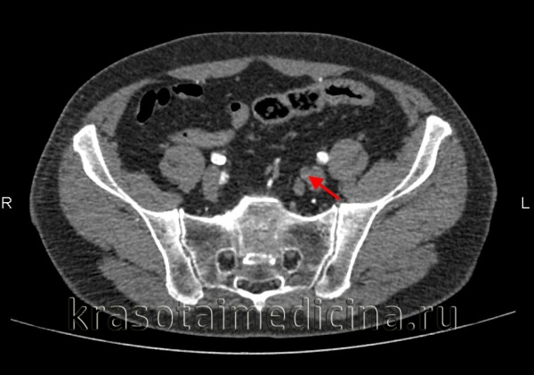 КТ-ангиография брюшной аорты и ее ветвей. Полная окклюзия просвета левой внутренней подвздошной артерии