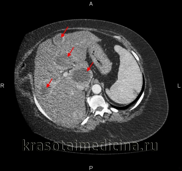 КТ органов брюшной полости. Множественные вторичные опухоли печени (первичная опухоль – рак молочной железы)