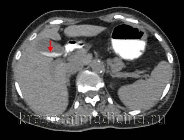 КТ органов брюшной полости. Кальциевое «молочко» в отлогих местах желчного пузыря (сладж). (фото Вишняков В.Н.)