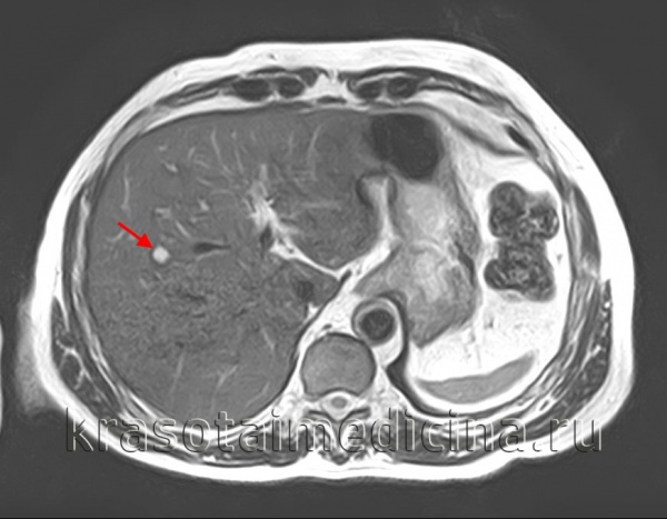 МРТ живота. Кистозное образование с гиперинтенсивным сигналом в правой доле печени