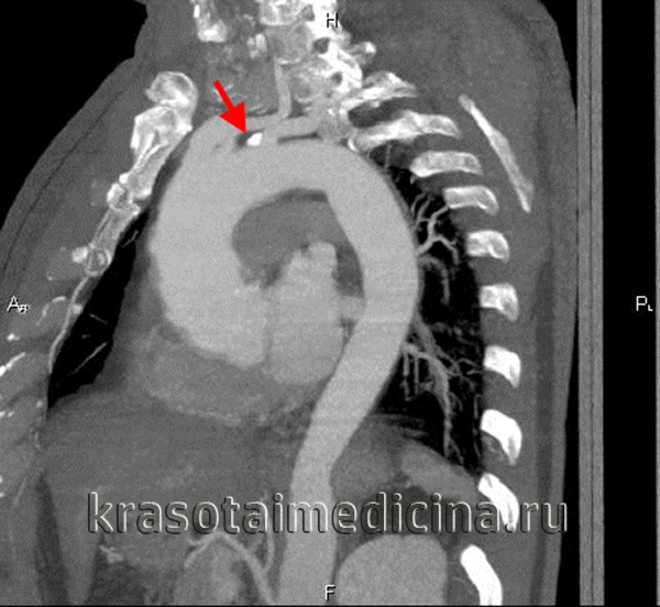 КТ-ангиография дуги аорты. Атеросклероз сосудов дуги аорты. Атеросклеротическая бляшка