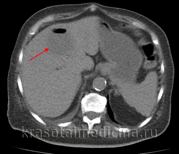 КТ ОБП. Гиподенсный очаг в правой доле печени с включениями газа (абсцесс печени)