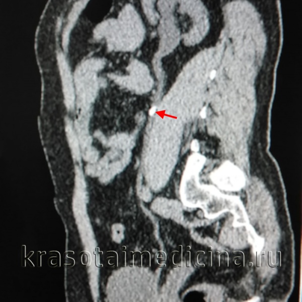 КТ ОБП и забрюшинного пространства (реформатированное изображение). Плотный конкремент в мочеточнике