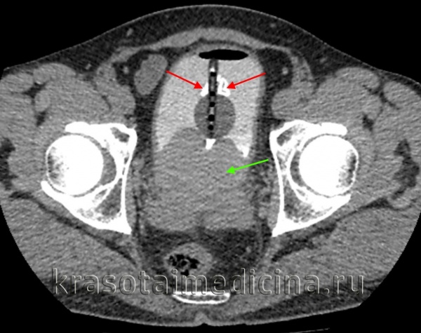 КТ урография, выделительная фаза. Камни в мочевом пузыре вблизи катетера (красные стрелки). У пациента аденома/гиперплазия предстательной железы (зеленая стрелка).
