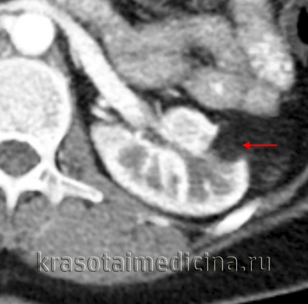 КТ ОБП и забрюшинного пространства. Объемное образование жировой плотности (-80…-90 ед. Хаунсфилда), деформирующее наружный край левой почки