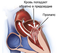 Малые аномалии развития сердца