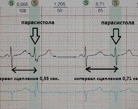 Парасистолия