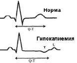 Гипокалиемия