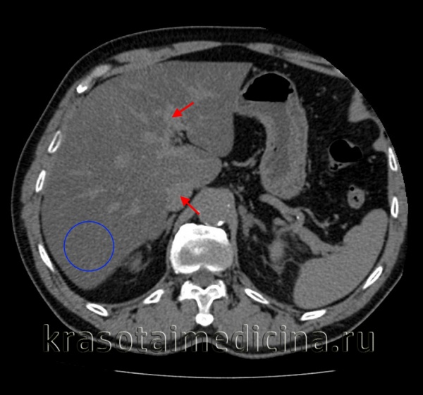 КТ ОБП (без контраста). Выраженный жировой гепатоз. Плотность паренхимы печени (синий круг) ниже, чем плотность вен (красные стрелки).