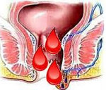 Ректальное кровотечение