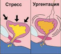 Недержание мочи