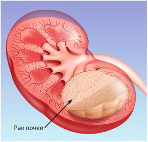 Рак почки