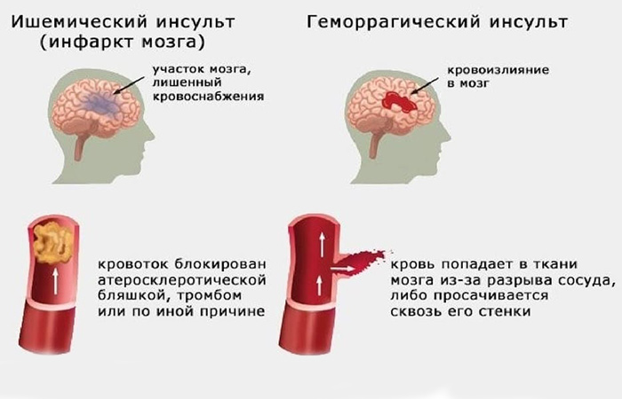 Виды мозгового инсульта