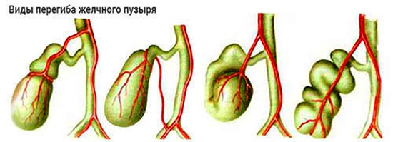 Виды перегибов желчного пузыря