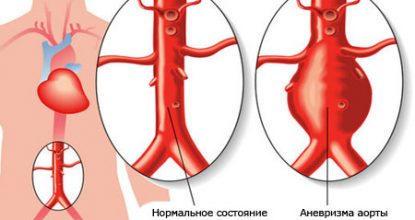 Аневризма брюшной аорты