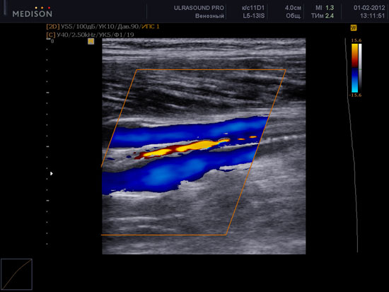 Дуплексное (УЗИ + УЗДГ) сканирование вен нижних конечностей