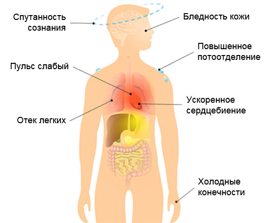 Симптомы и признаки кардиогенного шока