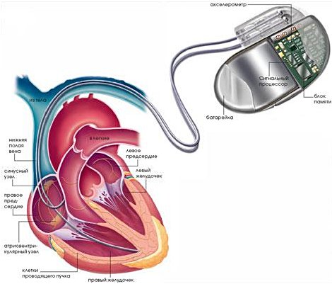  Имплантация электрокардиостимулятора