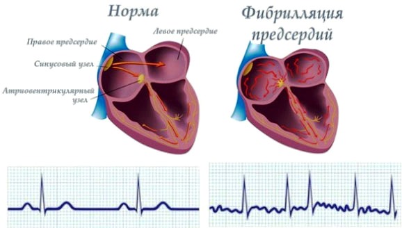 Фибрилляция предсердий