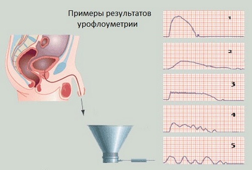 Первая УФГ является нормой. Остальные графики свидетельствуют о наличии отклонений