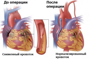 Аортокоронарное шунтирование