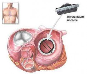 Протезирование клапанов